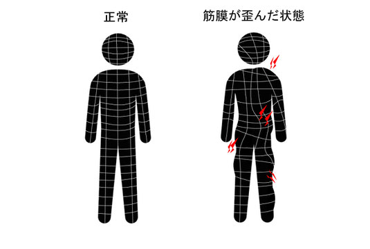 筋膜が歪むと骨格が歪みスタイルが崩れる。