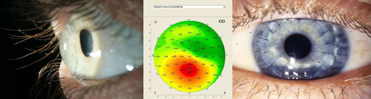 Vue latérale d’un kératocône; topographie d’un kératocône;  kératoplastie avec sutures en place 