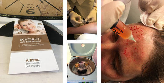 Personalized Cell Therapy von Arthrex