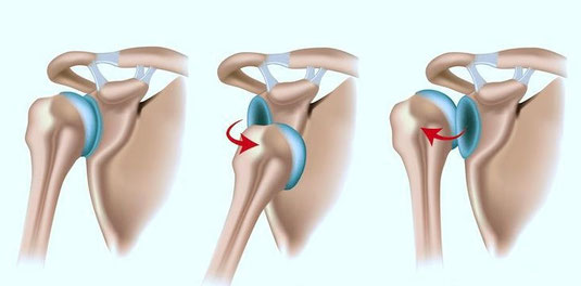 Links: Normale Schulter. Mitte: Vordere Luxation der Kugel. Rechts: Hintere Luxation der Kugel.