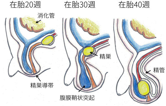 鼠経ヘルニア