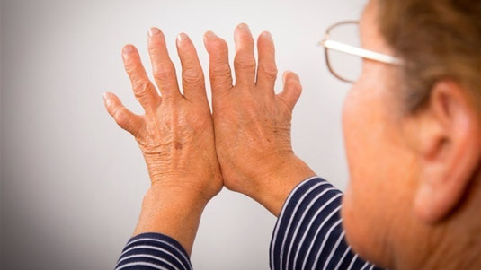 Sabías que la Higiene bucodental puede prevenir la artritis reumatoide, famident nuevo chimbote, famident chimbote