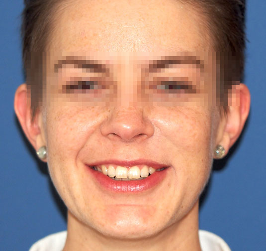 Weisser Hautkrebs: Basaliom Gesicht