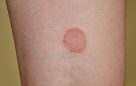 Lichen Ruber Homoeopathie Sissach Liestal Basel Olten Bern Zurich Luzern