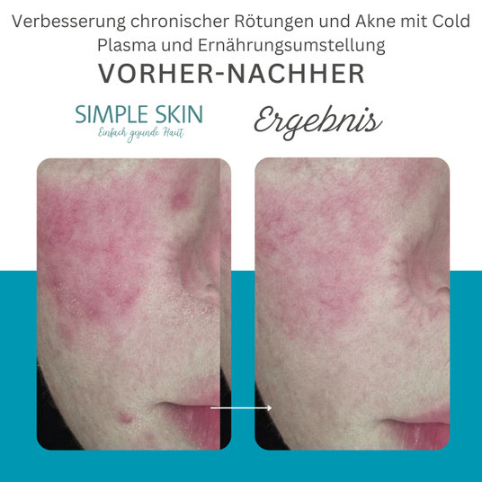 Akne Pickel Rötungen Rosazea Cold Plasma