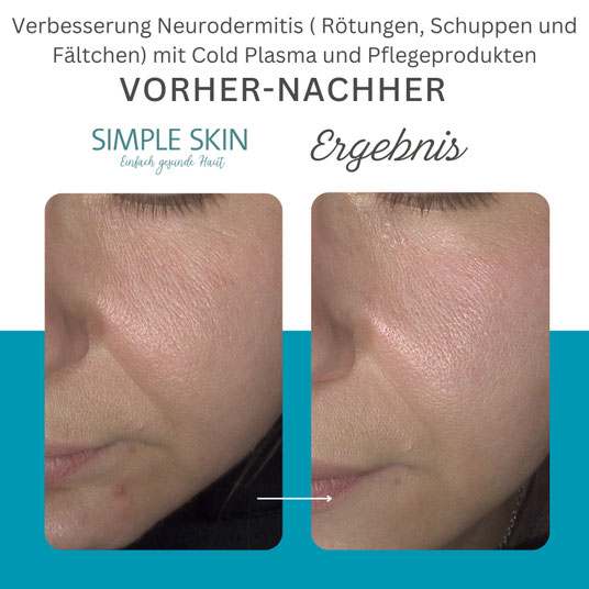 trockene haut neurodermitis falten rote flecken schuppen