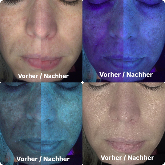 Microneelnig microdermabrasion Pickel Akne Pickelmale Narben