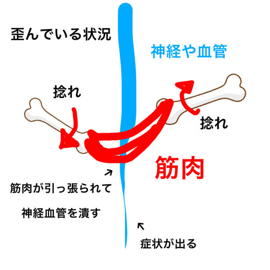 坐骨神経痛の本当の原因は体の歪みです、筋肉がねじれたりすることで神経を圧迫します。