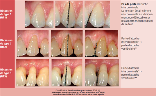 classification des récessions gingivales