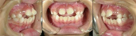 開咬 前歯で咬めない 開口 歯を失うリスクが高い不正咬合 治療期間 費用 外科矯正 東京の矯正歯科