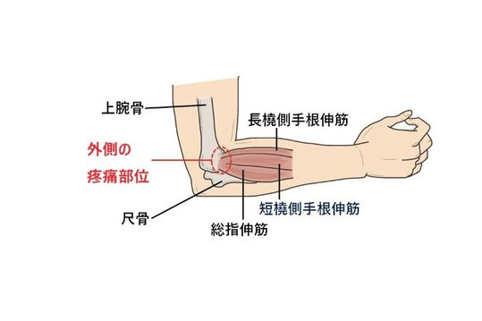 ゴルフによる肘の外側の痛み（外側上顆炎）の部位と、原因となる長橈側手根伸筋・短橈側手根伸筋・総指伸筋の解剖図