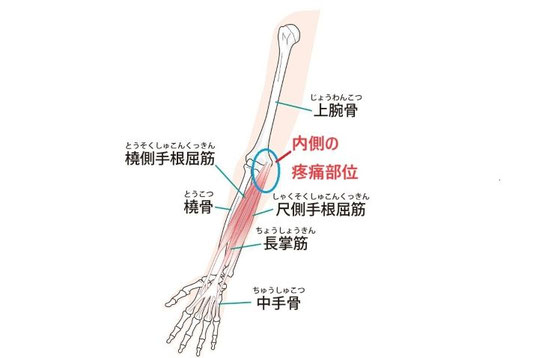 ゴルフ肘（上腕骨内側上顆炎）の痛みが出る部位と前腕の筋肉（橈側手根屈筋・尺側手根屈筋・長掌筋）の解剖図