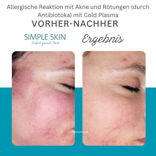 Allergische Reaktion auf Akne Antibiotikum