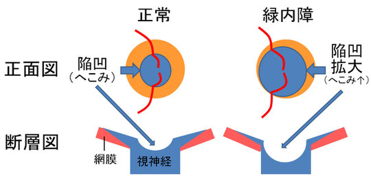 尼崎　眼科　緑内障　日帰り白内障手術　視神経