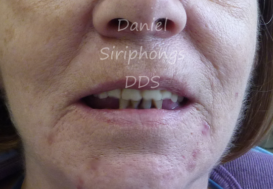 Dentures And Implants Can Look Like Real Teeth In Sulphur Springs Tx Gentle Dentist Sulphur Springs Tx
