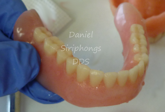 Lower denture