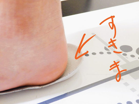 足底腱膜炎の原因