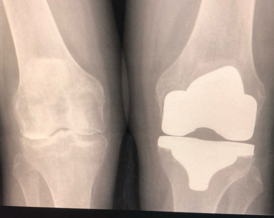 Postoperative Röntgenaufnahme Kniegelenksprothese