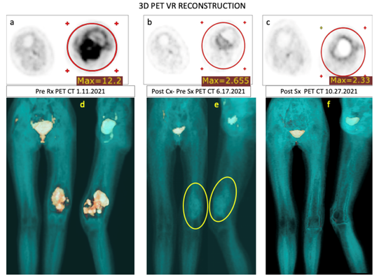 PET-CT-Bilder zeigen Tumorverkleinerung während der EISLI-Zyklen: Prä- und posttherapeutische 3D-Rekonstruktionen des Oberschenkelknochens, mit deutlichem Schrumpfen des Tumors und Rückgang der Lymphknotenmetastasen nach der Behandlung.