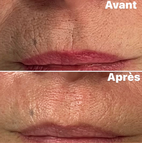 Avant/Après 1 séance microneedlind contour bouche: pore resserrés, peau plus lisse et lumineuse, rides estompées. Effet glow
