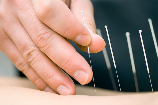 Akupunktur kann Migräneanfällen vorbeugen
