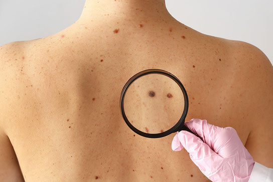 Durch regelmäßig durchgeführte Screenings Hautkrebs frühzeitig erkennen