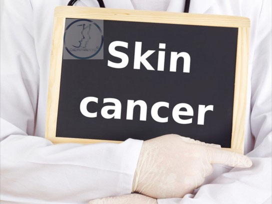 tratamiento del cancer de piel