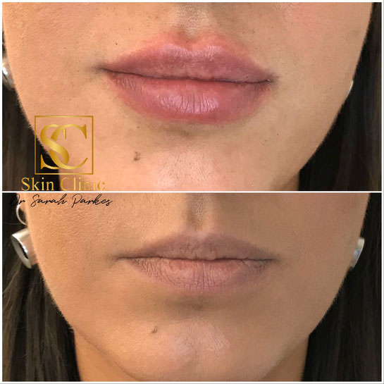 Dr Sarah Parkes Skin Clinic before and after lip filler picture