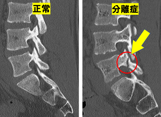 腰椎の正常時と分離時の比較