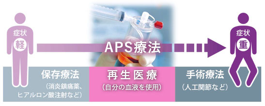 最新治療　再生医療　変形性ひざ関節症　変形性膝関節症　PRP療法 APS療法　名戸ヶ谷病院　柏　千葉　人工関節　人工膝関節置換術　切らずに治す　自己治癒力を高める