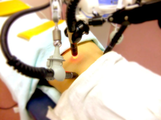 近赤外線 電子灸 星状神経にも 交通事故による頭痛や吐き気に