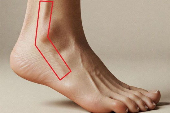 右足の外くるぶしの後ろから側面にかけて、腓骨筋腱の痛みが出やすい場所を赤い枠で示している