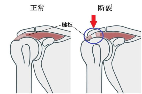 五十肩の原因となる断裂した腱板と正常な状態の比較イラスト