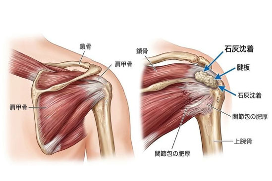 五十肩の原因となる石灰沈着が起きている肩関節のイラスト
