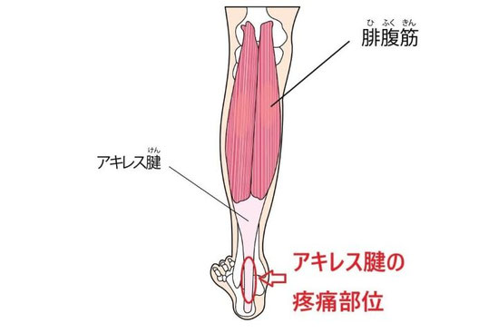 バレエによるアキレス腱の痛みが出る部位の解剖図（アキレス腱、ヒラメ筋など）