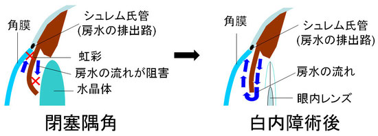 角 隅 緑内障 閉塞 急性