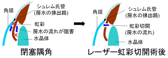 尼崎　眼科　緑内障　日帰り白内障手術　急性緑内障　緑内障発作　レーザー虹彩切開術　LI