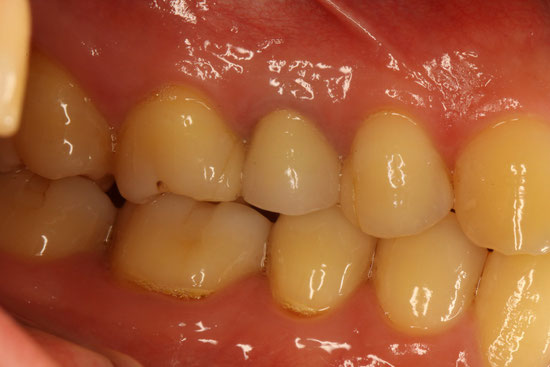 奥歯の歯茎再生