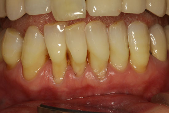重度の歯周病で歯茎が下がってしまった場合