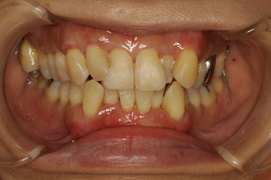 １回に７本の歯の歯ぐきの再生治療を行ったケース