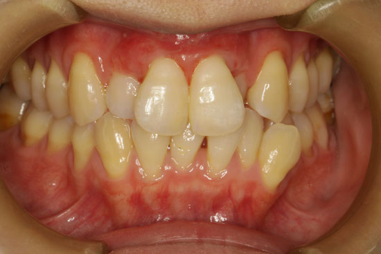 前歯の歯茎の再生治療
