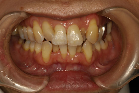 １回に７本の歯の歯ぐきの再生治療を行ったケース