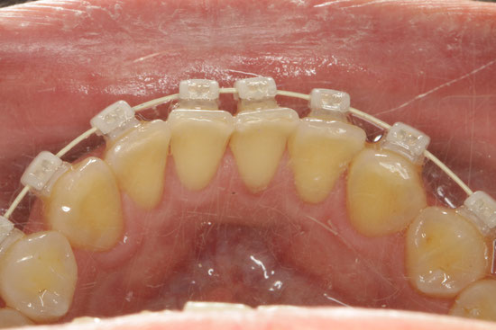 下の前歯の裏側の歯茎が下がってしまった時の歯茎の再生治療