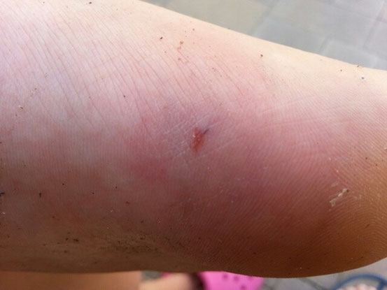 Lisa hat den Kampf gegen den Pazifik leider verloren...auch im Pazifik sind Steine und Muscheln scharf...