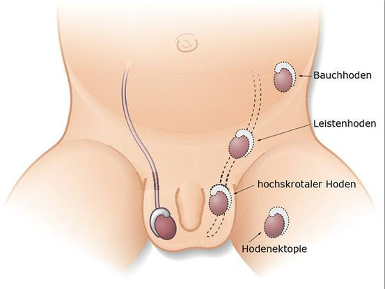 Absteigen des Hodens (Descensus testis). Lagevarianten beim Neugeborenen. Beim Absteigen kann der Hoden auch mal "falsch abbiegen" und im Oberschenkel zu liegen kommen.