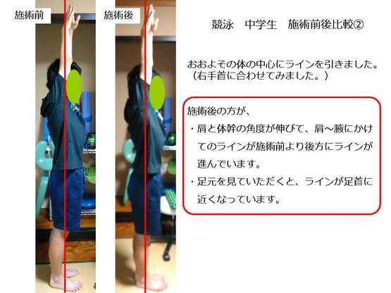 肩関節の痛み　姿勢　肩甲骨　肩甲骨痛み　背中の痛み　野球肩の原因　野球肩原因　野球肩治し方　野球肩体操　野球肩ストレッチ　野球　野球肩　肩が痛い　ピッチャー　リトルリーガーズショルダー　腱板損傷　投球傷害　水泳　競泳　腰痛　分離症　分離すべり症　水泳肩スイマーズショルダー　水泳肩　スイマーズショルダー治療　スイマーズショルダー治るのか　岐阜　岐阜市　岐阜市茜部　岐阜市東鶉　岐阜市南鶉　岐阜市中鶉　岐阜市柳津町　羽島市　羽島郡　笠松町　岐南町　茜部　鶉　東鶉　中鶉　南鶉　柳津　笠松　