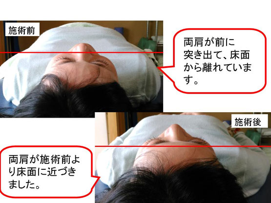 肩関節の痛み 姿勢 肩甲骨 肩甲骨痛み 背中の痛み 野球肩の原因 野球肩原因 野球肩治し方 野球肩体操 野球肩ストレッチ 野球 野球肩 肩が痛い ピッチャー リトルリーガーズショルダー 腱板損傷 投球傷害 水泳 競泳 腰痛 分離症 分離すべり症 水泳肩スイマーズショルダー 水泳肩 スイマーズショルダー治療 スイマーズショルダー治るのか 岐阜 岐阜市 岐阜市茜部 岐阜市東鶉 岐阜市南鶉 岐阜市中鶉 岐阜市柳津町 羽島市 羽島郡 笠松町 岐南町 茜部 鶉 東鶉 中鶉 南鶉 柳津 笠松