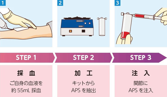 再生医療　PRP療法　APS療法　治療の流れ　名戸ヶ谷病院　整形外科　関節治療センター　千葉県　柏