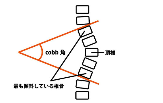 cobb角とは、頂椎と最も傾斜している椎骨をむすんだ角度をいう