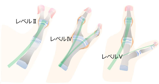 母指多指症のレベル別分類